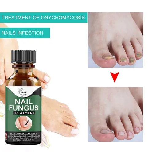 Nail Fungus Solution, Anti Infection Nail Fungus Removal Gel Original