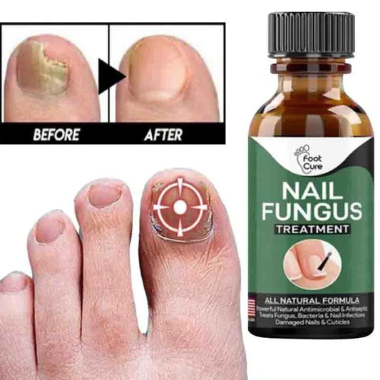 Nail Fungus Solution, Anti Infection Nail Fungus Removal Gel Original