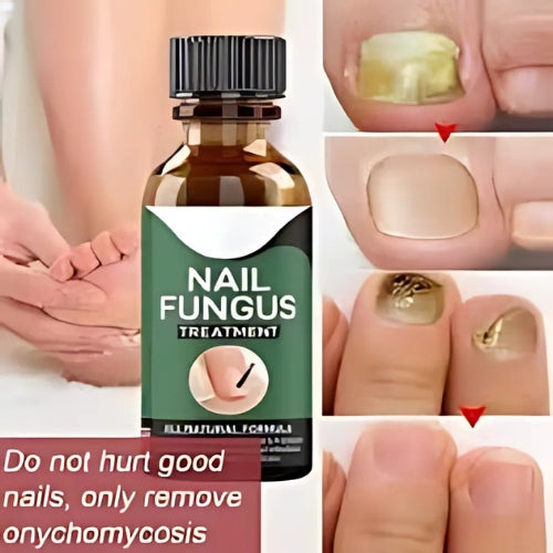 Nail Fungus Solution, Anti Infection Nail Fungus Removal Gel Original